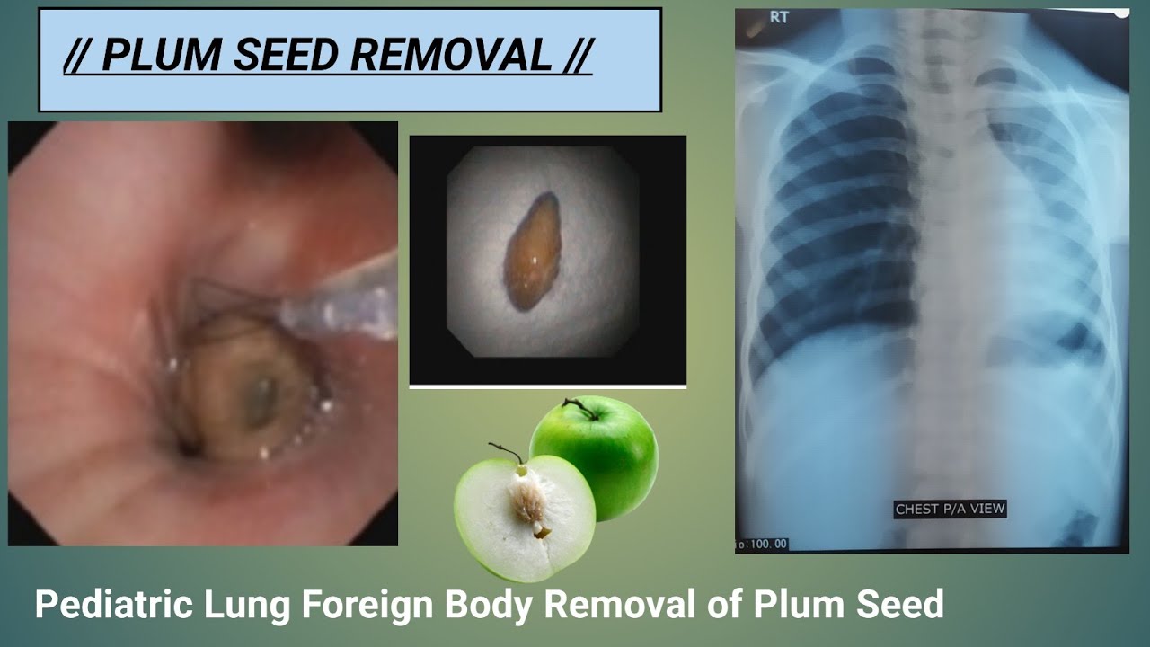 Plum Seed Removal ll Lung Foreign Body Removal at SQUARE HOSPITAL LTD