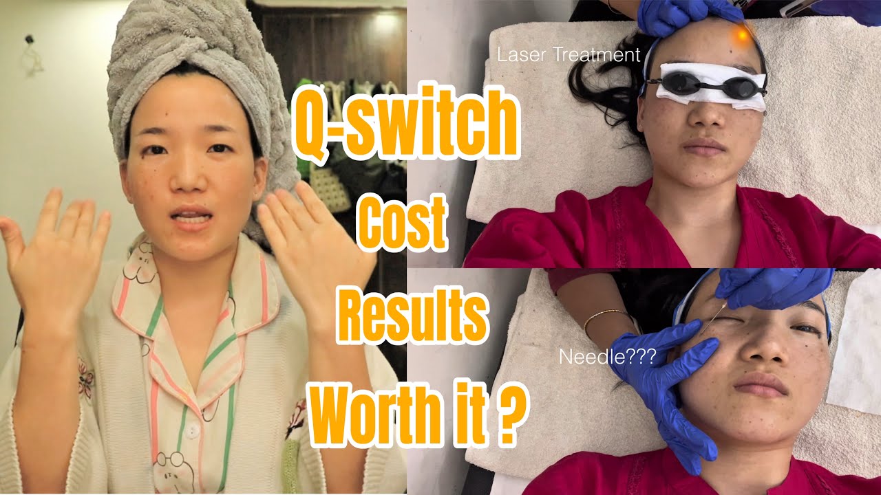 My Honest Review of Q-Switch Laser Treatment in Delhi | Worth it or Not?