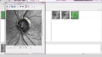 Case Study with SPECTRALIS OCT: Glaucoma