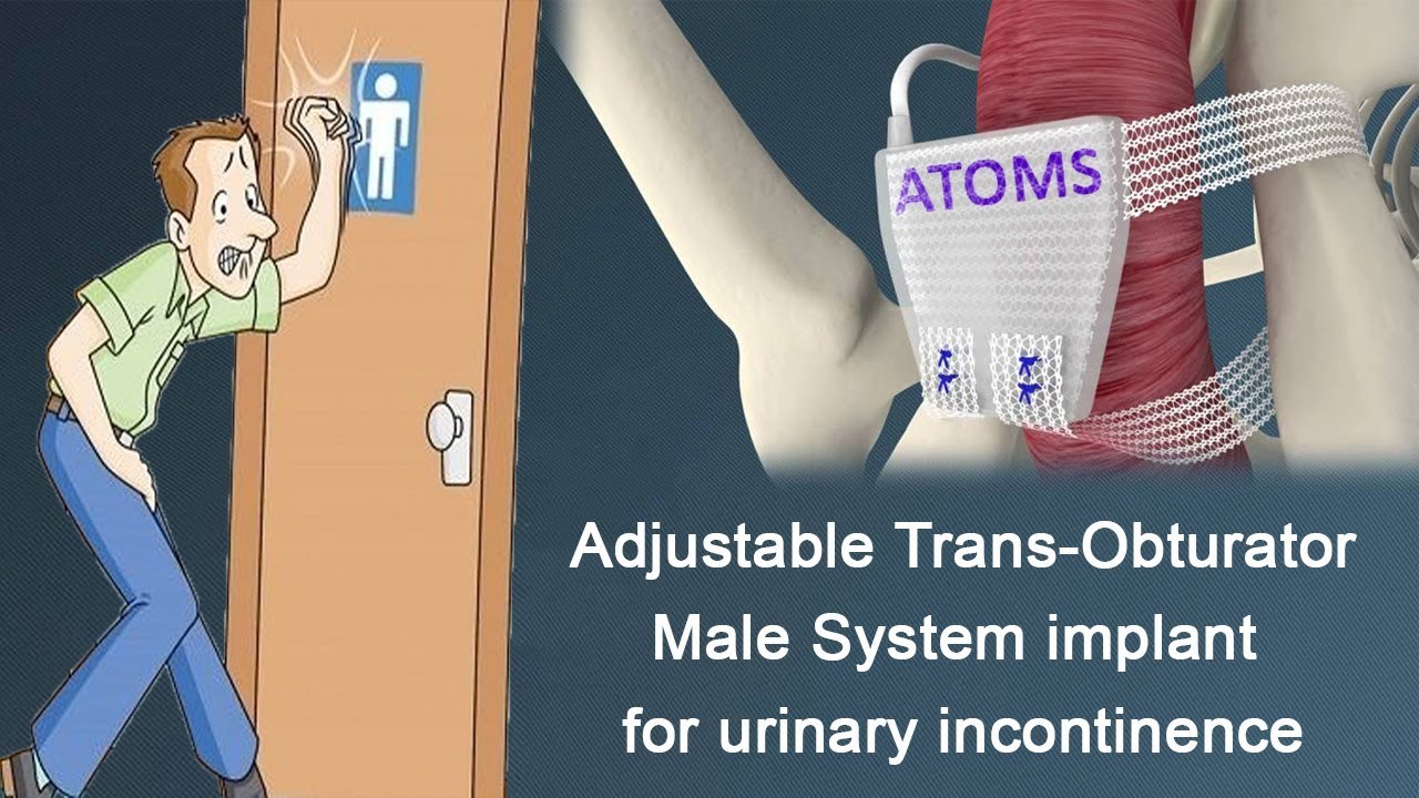 Transobturador ajustable trata la incontinencia masculina
