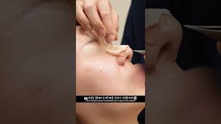 코성형 5일차 부목제거!
