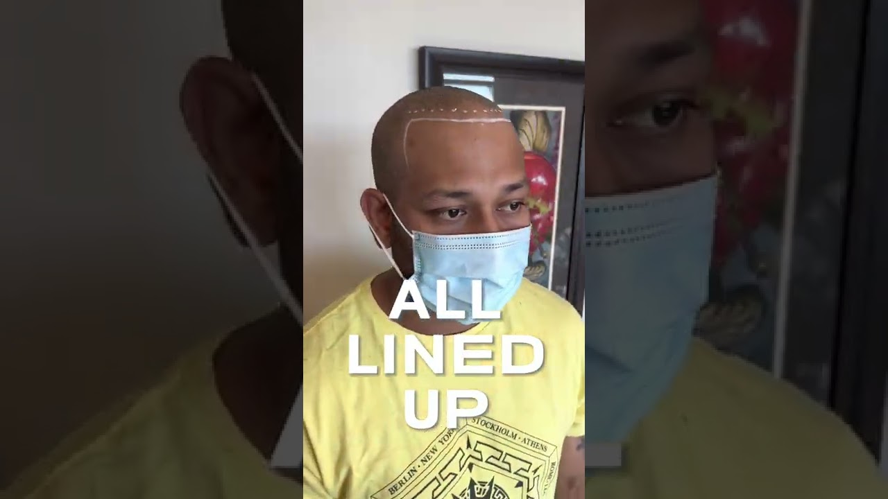 SMP Repair & Hair Transplant Cover Up - Scalp Micropigmentation