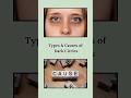 #DarkCircles #UnderEyeCare #PigmentedDarkCircles #DrMonikaParmar #GuardianOfRemedy #EyeCareTips