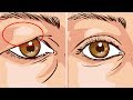 How To Treat Droopy Eyelids Naturally... The Results Are Amazing!