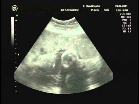 Ultrasound scan at 35 week pregnancy