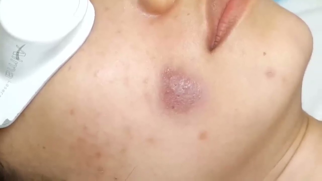 HHV Clinic | Đỗ Thu Hiền | Hiền Vân Spa-These moments in acne extraction 5