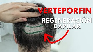 REGENERAR PELO y CICATRIZ con NUEVO TRATAMIENTO (VERTEPORFIN)