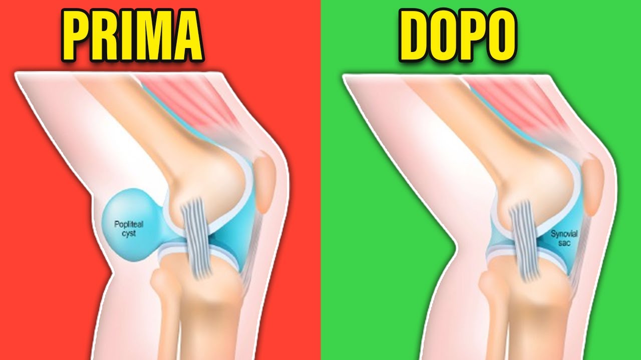 Fai Sparire la Cisti di Baker Così