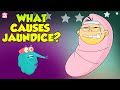 Jaundice | Causes of Jaundice | The Dr Binocs Show | Peekaboo Kidz