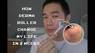 how derma roller change my life in 2 weeks (dealing with acne scars) + how to use
