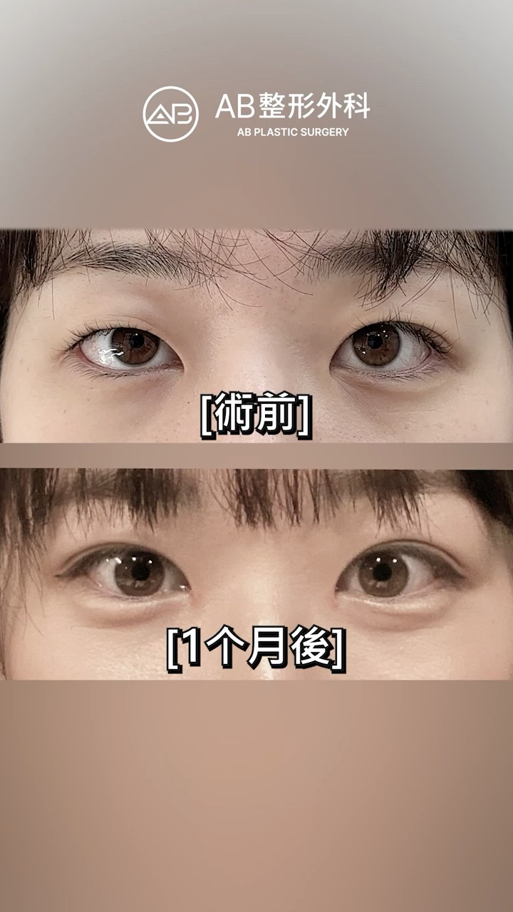 不同雙眼皮高度對比 #shorts