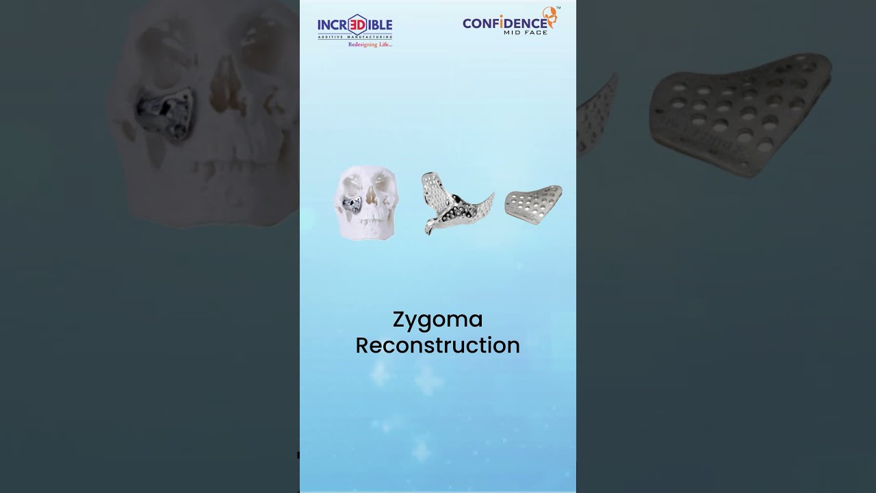 Top 7 Solutions For Pre Post Mucormycosis Resection By 3D Incredible Completed 600 Implants 