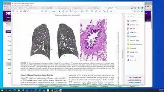 Extracting data from a case report for an evidence synthesis project