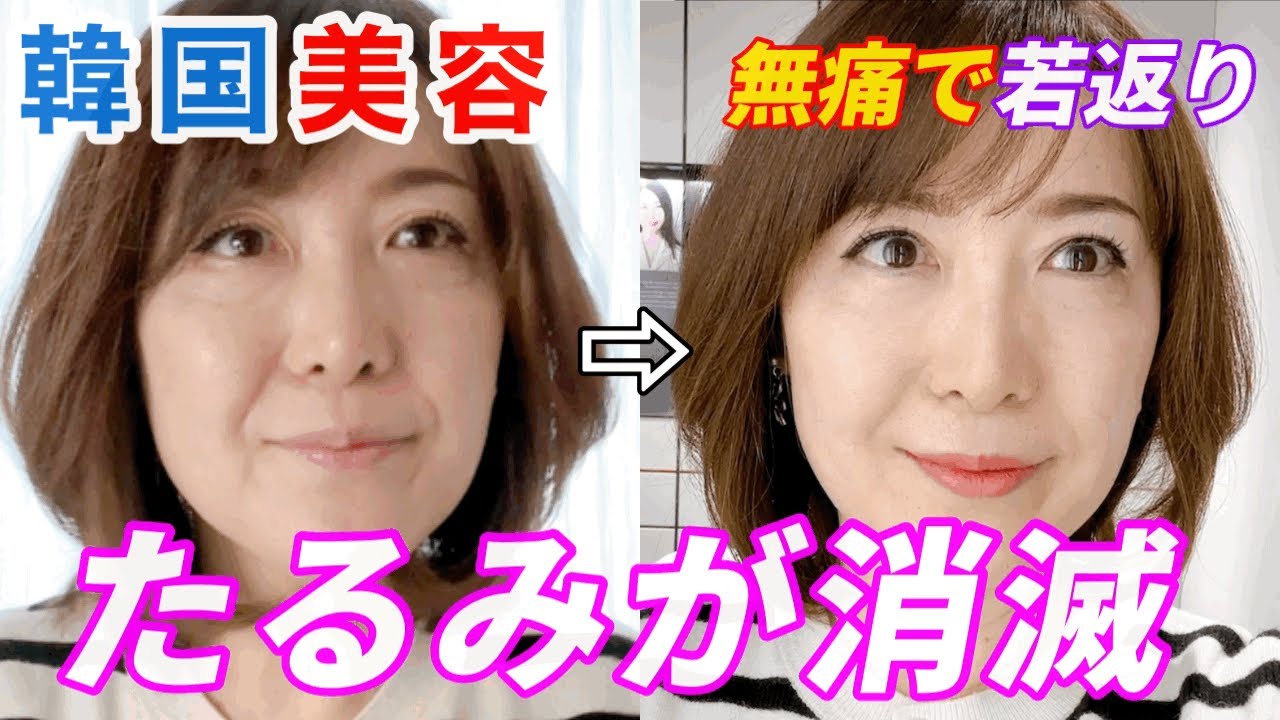 【韓国美容】たるんだ頬を上げてー10歳！速攻アンチエイジング！61歳リフトアップ