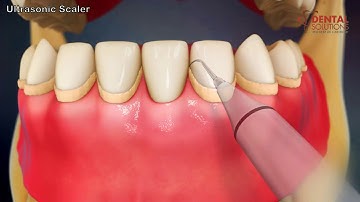 Ultrasonic Scalers: Clinical Use and Benefits