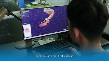 So sánh Trụ phục hình cá nhân hóa và Trụ phục hình thông thường | Nha Khoa Nụ Cười