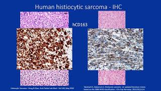 Laura Janke Presents Histiocytic Sarcoma in Mice || Academy of Genomic Pathologists Rounds 2.25.21 screenshot 3