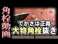 【 角栓抜き動画 】大きな角栓を抜いていく角栓抜き動画～A video of a blackhead remover removing large blackheads