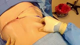 A bra line back lift was preformed on this patient to remove all lo...