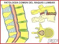Patología común del raquis lumbar