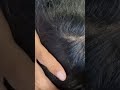 #fypviralシ #statisfying #lice #hair #LiceOnHead #liceremoval  #brasil #xyzbcafyp #licecomb  #kutu