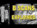 ultrasound - B scan explained