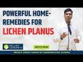 Powerful home remedies for lichen planus