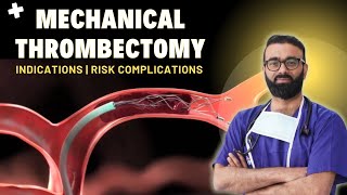 What Is Mechanical Thrombectomy? Stroke Treatment Explained | Dr. Biplab Das