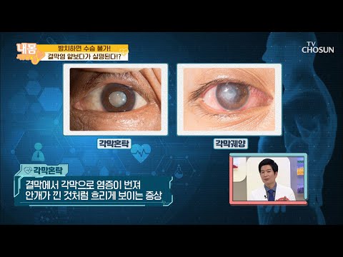 《결막염 합병증》 방치하면 수습 불가! [내 몸 사용설명서] 310회 20200710