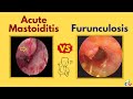 Acute Mastoiditis vs Furunculosis | Differences
