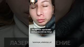 ЛАЗЕРНОЕ УДАЛЕНИЕ ОБРАЗОВАНИЯ НА ЛИЦЕ!!! УДАЛЕНИЕ РОДИНКИ НА ЛИЦЕ!!!