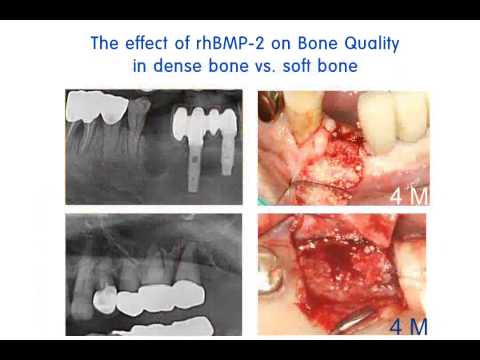 Wideo: Skuteczność Kompozytu Hydrożelowego Obciążonego RhBMP-2 Na Tworzenie Kości Wokół Implantów Dentystycznych W Ubytkach Kostnych żuchwy U świnek Miniaturowych