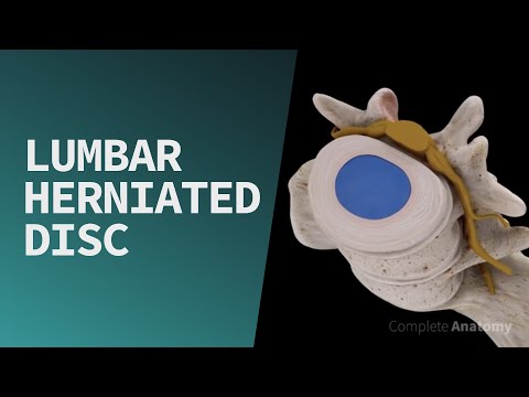 Chiropractic Education of the Lumbar Disc: www.chiroup.com. 
