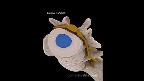 Lumbar Herniated Disc - DayDayNews