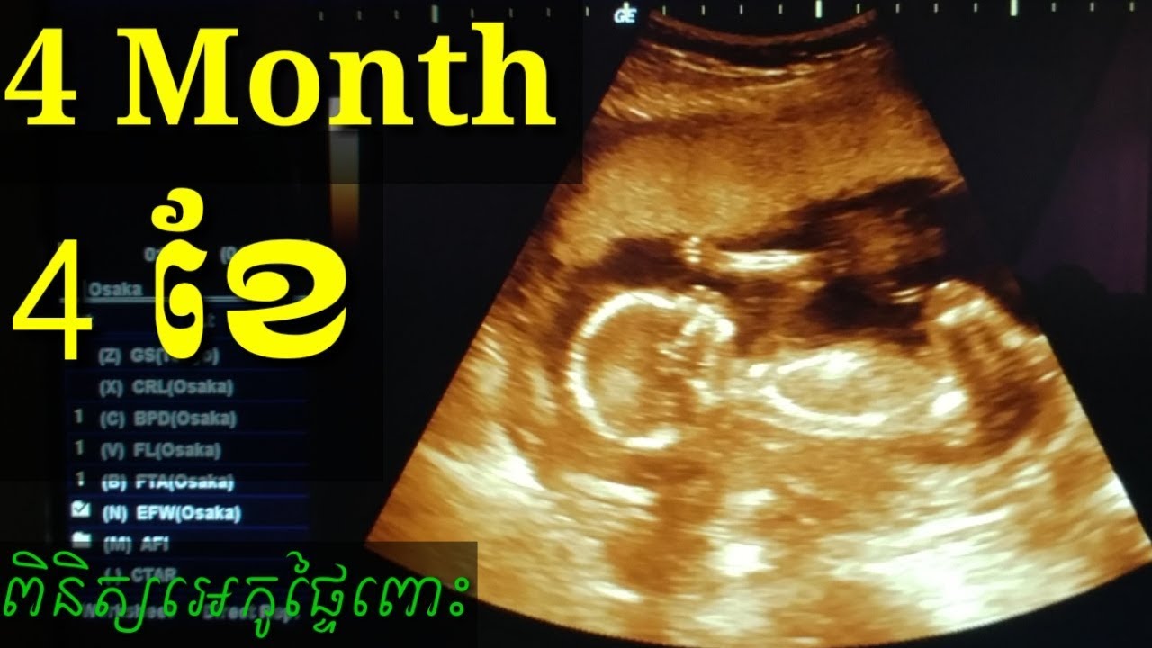ពិនិត្យឣេកូផ្ទៃពោះ 4ខែ pregnancy ultrasound 4month by Dr.Bun laysophea