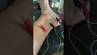 Plantar Fasciitis, Foot Pain, Heel Pain Relief - Dry Needling Therapy New Orleans, LA