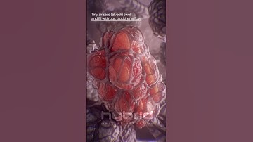 Pneumonia & alveoli up close | medical animation | #pneumonia #pneumoniaanimation #medicalanimation