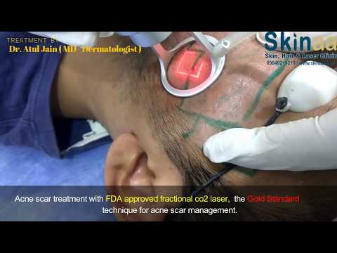 Acne Scar Treatment by FDA Approved Fractional Co Laser | Skinaa Clinic