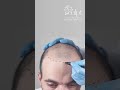 Complete Guide to Hair Transplant Surgery in Hyderabad | Everything You Need to Know #hairtreatment