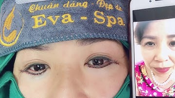 Cắt mí mât dưới tại EVA SPA #chinhnguyen#catmiduoi #phauthuatthammi #daotaohocvien