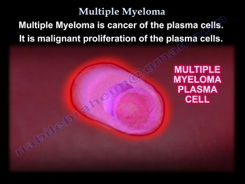 Multiple Myeloma - Everything You Need To Know - Dr. Nabil Ebraheim ...