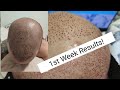 Hair transplant in Turkey | Look what happened in the first week! - Dr Cinik Istanbul