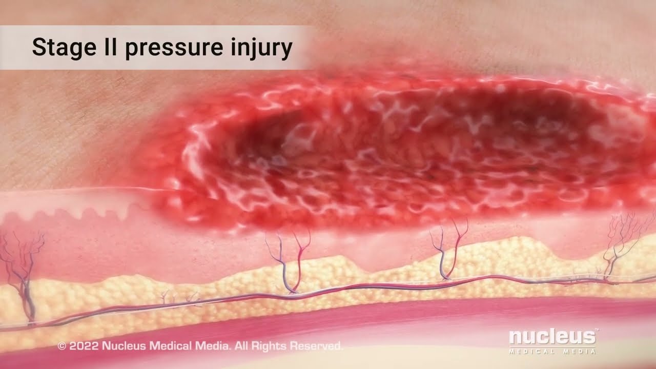 Stage 3 pressure injury. Figure 7. Stage 3 pressure injury with epibolle. |  Download Scientific Diagram