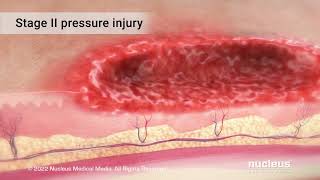 Pressure Injuries