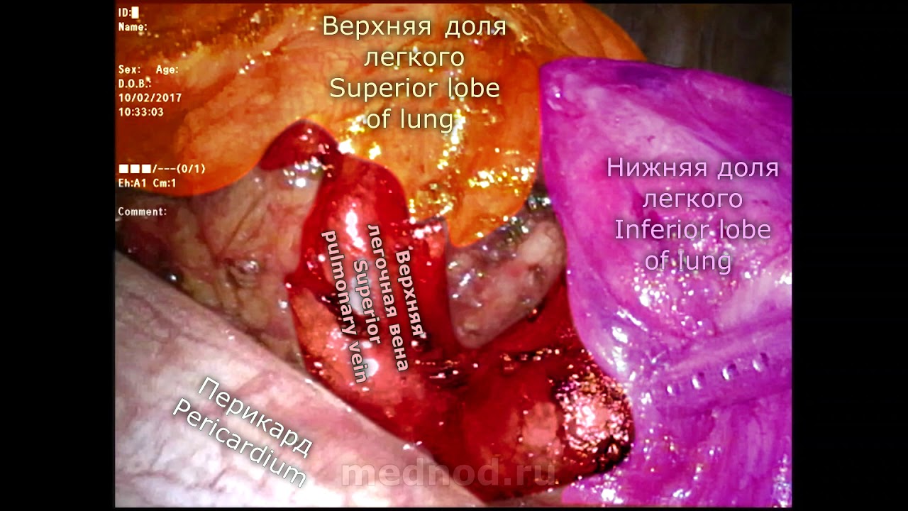 Торакоскопическое удаление верхней доли левого легкого при опухоли
