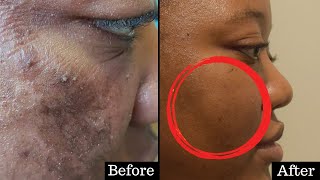 Will Dermazeam Work for You eczema hyperpigmentation folliculitis