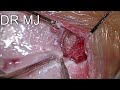 Cochlear Implantation in Mondini Deformity with Abnormal Anatomy
