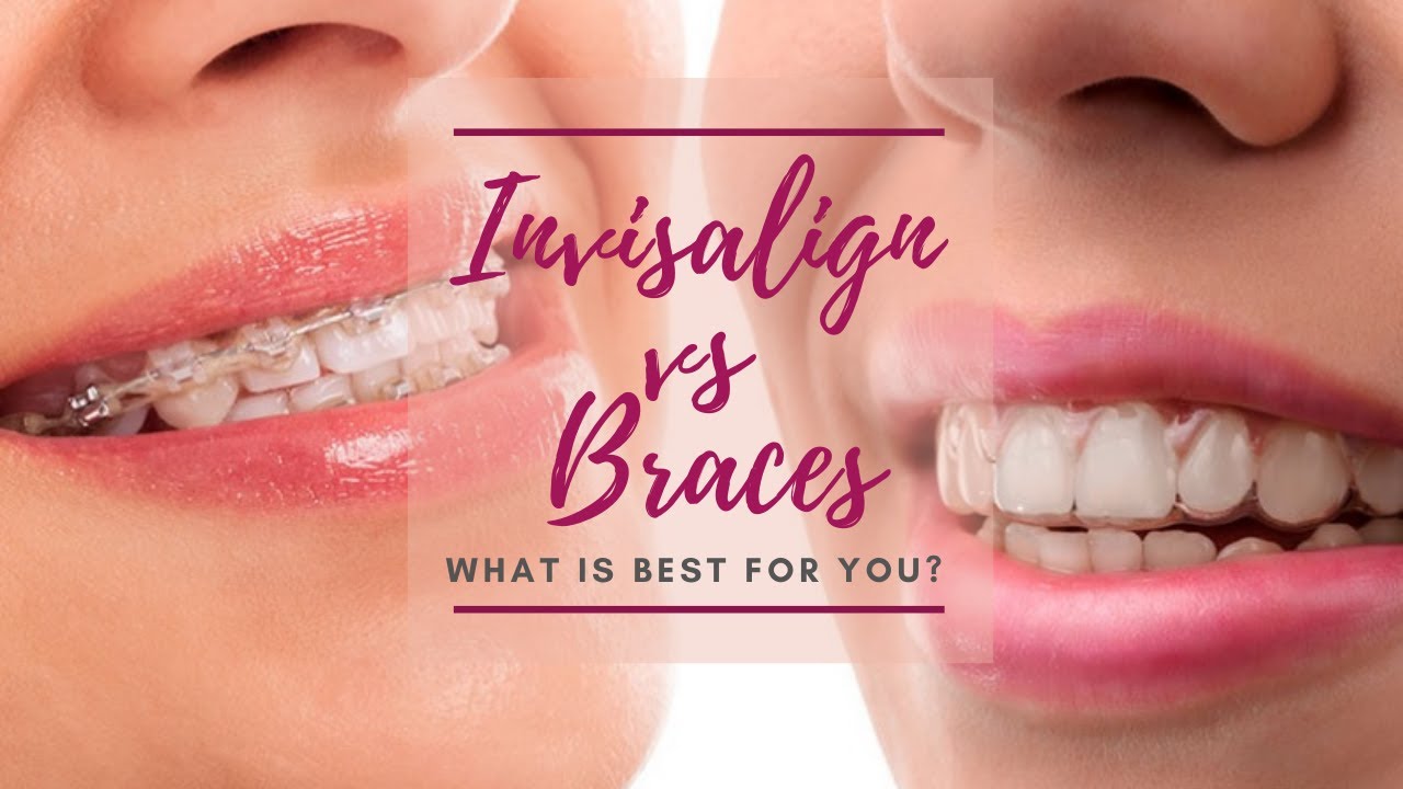 Для зубов отзывы врачей. Каппы Инвизилайн. Элайнерах Invisalign. Невидимые брекеты элайнеры. Ортодонтические каппы элайнеры.