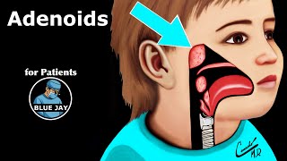 Adenoids and Adenoidectomy: Patient Education