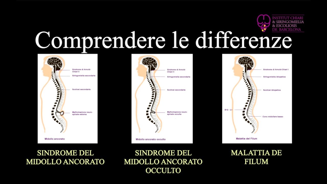 Differenze: Sindrome del midollo ancorato, Sindrome del midollo ancorato occulto e Malattia de Filum